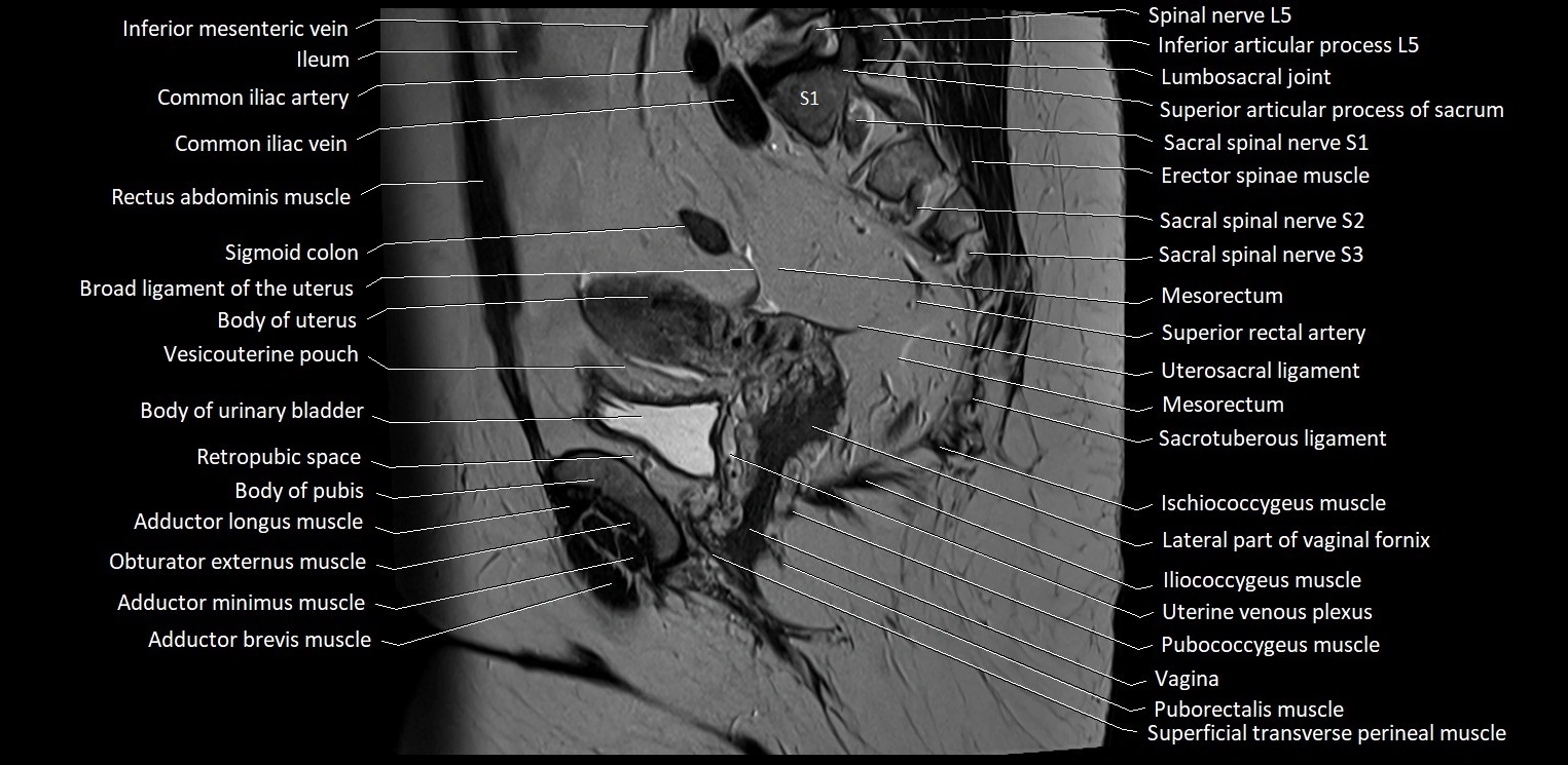 Sagittal cross sectional anatomy of female pelvis (MRI 3T) image 27.webp